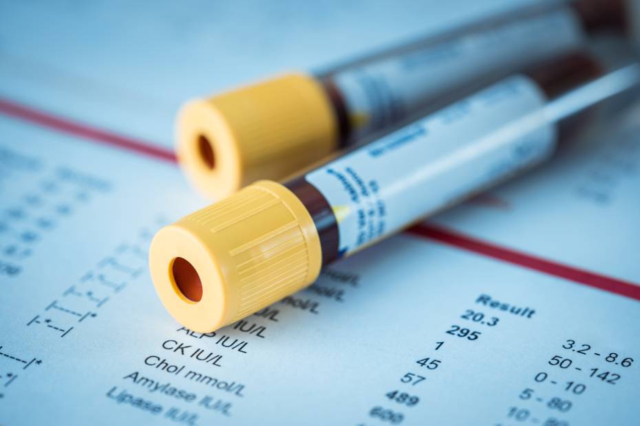 Image de deux tubes d'analyse contenant du sang qui se trouvent sur une feuille de résultats d'analyse sanguine